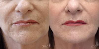 Reduce Face Wrinkles using Mesotherapy | Clinique Chloe - Wrinkles and fine lines of the face appear over time following repeated movements as well as with the gradual loss of collagen. This condition can be effectively treated with mesotherapy.