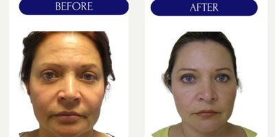 55-64 year old woman treated with Thread Lift, MINT threadlift - mint threadlift