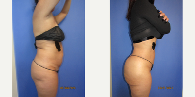 45-54 year old woman treated with Brazilian Butt Lift, Vaser Liposuction - Vaser ultrasound 360 liposuction PAL with fat transfer buttocks
