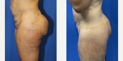 35-44 year old woman treated with Silicone Injection Removal - A 43-year-old female patient weighing 210 pounds had 6 rounds of raw silicone injected in 2004, which caused her a multitude of problems. After two rounds of unsuccessful silicone removal (open technique) in Columbia, she sought out renowned Dr. J. Timothy Katzen in Beverly Hills for a revision surgery to remove the remaining silicone injections. After 4 hours of surgery, 6.5 pounds of the silicone was successfully removedleaving her feeling relieved and ecstatic of the results!