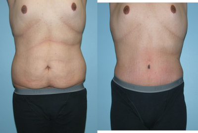 Male Abdominoplasty - Male Abdominoplasty, Male Tummy Tuck