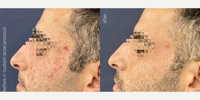 Man treated with AviClear, Microneedling - Reclaim your confidence and rediscover your glow with a Custom Acne Protocol designed just for you!Banish breakouts, & uncover smoother, clearer skin with the combined power of our customized treatment options. AviClear + Diamond Glow + SecretDUO + Glass Skin Facial Glowing skin!