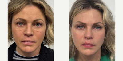 45-54 year old woman treated with Eyelid Surgery - 5 months after an upper eyelid blepharoplasty and Retin A to lower eyelids