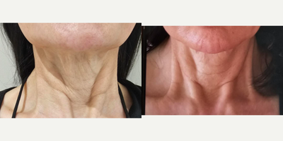 65-74 year old woman treated with Profhilo - Female 70 years treated with Skin Booster Profhilo on neck, only after 1 session