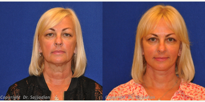 Chin Liposuction - Chin Liposuction