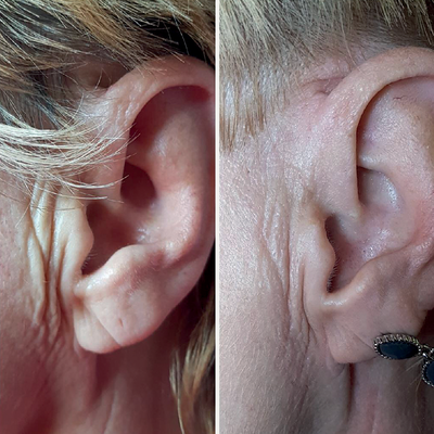 55-64 year old woman treated with Plasma IQ - 55-64 year old woman treated with Plasma IQ