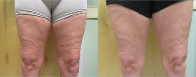 Woman treated with BodyFX - S.D. Body FX for cellulite upper thigh