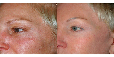 35-44 year old woman treated with eMatrix - 3 Treatments of eMatrix Sublative Skin Resurfacing