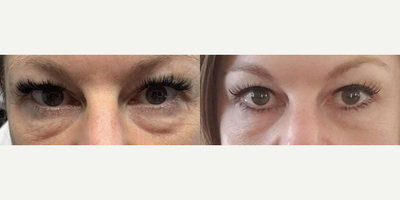 35-44 year old woman treated with Microneedling - Gender: FemaleEthnicity: CaucasianAge: 41 - 50Procedure: Agnes RF