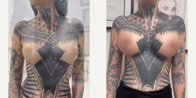 Woman treated with Breast Augmentation - These before and after are only one week apart!Imagine how theyll look when they fully drop and fluff. Typically about 3-6 months.