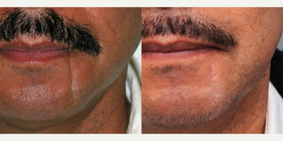 Face Scar Revision - This 45-year-old man came in asking for improvement in the appearance of his lower face scar. The scar had been bothering him for more than 10 years, and he finally decided to do something about it.&nbsp;