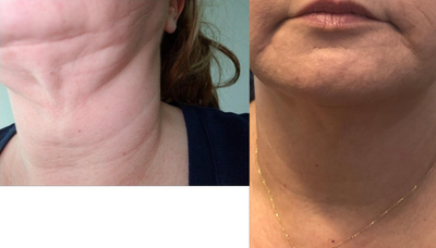 35-44 year old woman treated with AccuTite - 40's y/o female who had Accutite treatment for skin tightening.