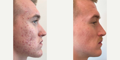 21 year old man treated with Accutane - This patient was struggling with severe active acne, after 6 months of Accutane there was major improvement.