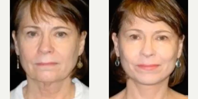 Woman treated with Facial Fat Transfer - 12 Ways Plastic Surgery Can Transform You:5 USING YOUR OWN FAT. Did you know that your own fat from your body can be used and injected into other areas to achieve specific aesthetic goals? Check out a few of the ways fat grafting can enhance your body