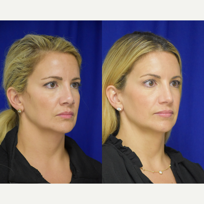 35-44 year old woman treated with Revision Rhinoplasty - Rhinoplasty Revision