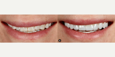 Woman treated with Teeth Whitening - Woman treated with Porcelain Veneers, Teeth Whitening, Smile Makeover