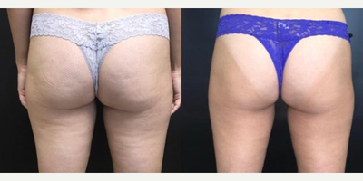 Woman treated with Velashape - This patient had 5 sessions of Velashape and got amazing results.