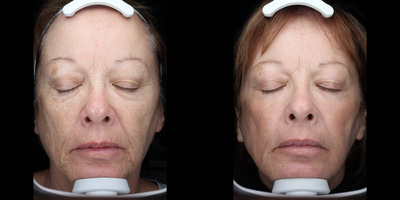 65-74 year old woman treated with ProFractional Laser - Patient had a Profractional with PRP done to her whole face and was given post care skin care products
