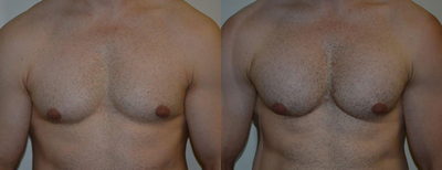 Male Treated for Lack of Chest Definition - Before and after pectoral augmentation with implants.&nbsp;Dr. Jerome Edelstein