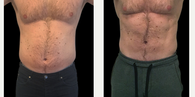 Emsculpt - Photo provided courtesy of BTL Industries, Inc., performed by Anita Sturnham