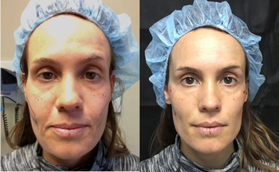 34 year old woman treated with Silhouette InstaLift - 34 year old woman treated with Silhouette InstaLift with concerns regarding her nasolabial folds. Patient did not like the appearance of bulk and heaviness as well as laxity in this area. She also has some concerns about her jowls. The treatment helpedcorrect the signs of aging by lifting the nasolabial folds and refining the contours of her cheek and mid-face as well as lifting her jowls. Patient also received cosmetic filler,Radiesse in the temporal area to restore the natural appearance of her temples.