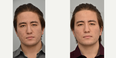 18-24 year old man treated with Vivace - Vivace microneedling delivers radiofrequency heat energy into the skin through deep channels created by many small needles. This stimulates production of collagen, and the channels also help the skin absorb topical serums. This patient has only had 1 treatment, but at least 3 are recommended for full results.