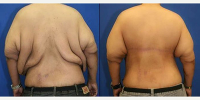 45-54 year old man treated with Back Lift - This is a male patient who lost a significant amount of weight. He had a massive amount of excess skin and fat in his back and torso area. He underwent a horizontal torsoplasty, aka a back lift.