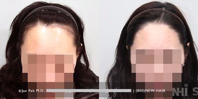 18-24 year old woman treated with Forehead Reduction - Forehead Reduction
