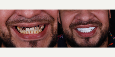 35-44 year old man treated with Dental Implants, Porcelain Veneers, Dental Crown, Tooth Repair - Dental implants and smile design with ceramic veneers, aesthetic result, maintaining functionality