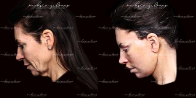 45-54 year old woman treated with Deep Plane Facelift, Neck Lift, Lip Lift, Brow Lift, Eyelid Surgery - This 45-54-year-old patient underwent a combination of Deep Plane Facelift, Neck Lift, Lip Lift, Eyelid Surgery, and Brow Lift to achieve a comprehensive facial rejuvenation. The Deep Plane Facelift and Neck Lift addressed sagging skin and restored youthful contours, while the Lip Lift enhanced the appearance of her lips, creating a more balanced and refreshed look. The Eyelid Surgery (blepharoplasty) rejuvenated her eye area by removing excess skin and reducing puffiness, and the Brow Lift provided an uplifted and more awake expression. At just 1 week post-operative, early signs of improvement are already visible, with swelling and bruising expected to subside over the coming weeks. The results will continue to refine, showcasing the transformative effects of these procedures.
