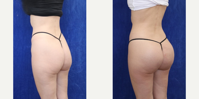 Woman treated with Butt Augmentation - Woman treated with Butt Augmentation