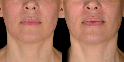 35-44 year old woman treated with Exilis - Patient treated with BTL Exilis Ultra with small applicator for lips. One treatment per week for four weeks.