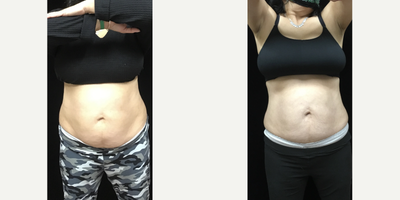 Woman treated with truSculpt iD - Body contouring/fat loss with TruSculpt ID.