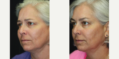 50 year old woman treated with Botox for Migraines - 50 year old woman seeking to address early signs of aging consulted with Dr. Kris Reddy FACS. Dr. Reddy performed Botox about 40 units and dermal fillers (1 syringe of Juvederm Ultra in the nasolabial folds and perioral lines and 1 syringe of Voluma for the lower face and chin area). Patient wanted to have Botox performed for cosmetic reasons and to treat migraine headaches.