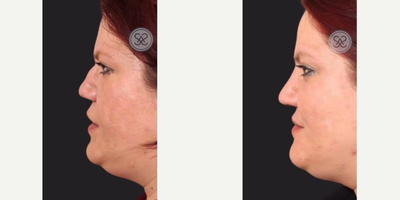 Woman treated with Rhinoplasty - BEAUTIFUL SCULPTED NOSEThe Rib Graft technique was used to take a piece of this patient's rib to reconstruct her nose, giving this beautiful natural look.