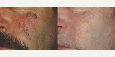 Man treated with Pulsed Dye Laser - Man treated with Pulsed Dye Laser