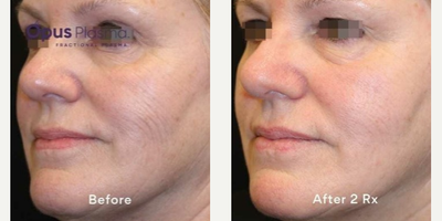 Woman treated with Opus Plasma - Woman treated with Opus Plasma