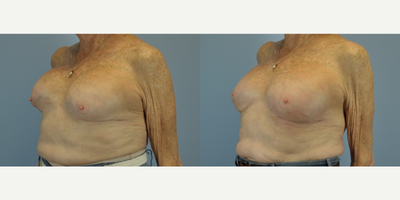 75 and up year old woman treated with Capsular Contracture Treatment - This patient was treated surgically for capsular contracture.