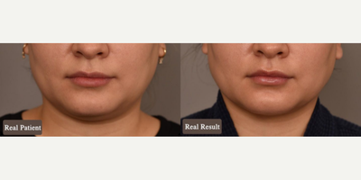 Woman treated with Chin Liposuction - Woman treated with Chin/Neck Liposuction as well as Cheek Liposuction. Pre-op, patient requested more refinement of her jawline and profile features.