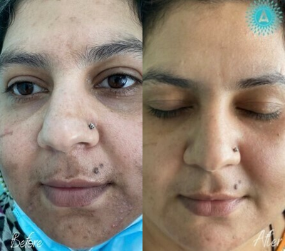 Woman treated with Clear and Brilliant - Woman treated with Clear and Brilliant