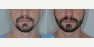 Man treated with Beard Transplant - 1 year after 1800 grafts to beard