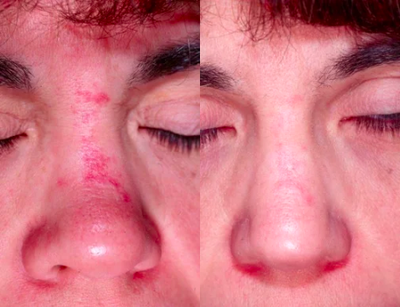 Vbeam Laser Treatment - 	Young patient before and after Vbeam laser treatment to reduce port wine stain on his nose.