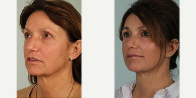 53 year old woman treated with Facelift and Lower Lid Laser Resurfacing - Patient had lower facelift and lower lid Co2 laser resurfacing