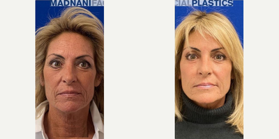 56 year old woman treated with Voluma - 56 year old woman treated with Juvederm ultra to treat her laugh lines and volbella to her perioral lines. She also received voluma to the cheeks.