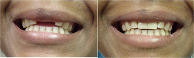 Mini Dental Implants replacing missing front teeth - Patient has been missing her two front teeth for the last 12 years. Two mini dental implants were placed, patient left our office with temporary crowns. The entire office visit lasted less than 1 hour.