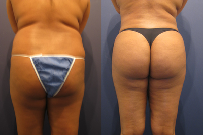 Young woman interested in liposuction and improved contour of her buttocks - This young woman underwent liposuction of her hips and abdomen, and transferred the fat into her gluteal region.