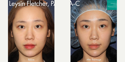 Woman treated with Thermage - Woman treated with Thermage