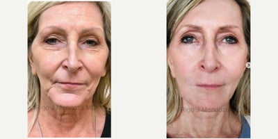 55-64 year old woman treated with Facelift, Neck Lift, Renuvion for Facial Resurfacing, Radiesse - This patient complaints included lax skin and loss of volume. To address her facial rejuvenation, she had the following procedures and treatments: Face Lift Neck Lift Facial Renewal Skin Resurfacing with Renuvion J Plasma of her face, eyes, neck and decollete. Radiesse dermal filler to her jawline to give her definition as well as correct asymmetry in the front of her jaw Radiesse dermal filler to her chin to increase loss of volume Hyper-diluted Radiesse to her perioral and cheeks to increase loss of volume and stimulate collagen Xeomin in her forehead, crow's feet and glabellar Skincare routine including ZO Skin Health and SkinCeutical products
