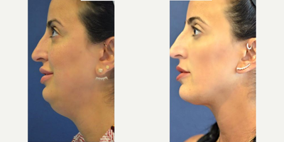 Woman treated with Neck Lift - Woman treated with Neck Lift