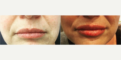 Woman treated with Lip Augmentation - Woman treated with Lip Augmentation